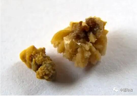 草酸钙结石的预防