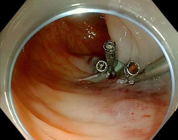 内镜ESD黄金刀图片